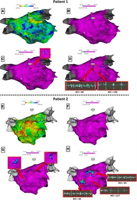 High-density mapping of the average complex interval helps localizing atrial fibrillation drivers and predicts catheter ablation outcomes